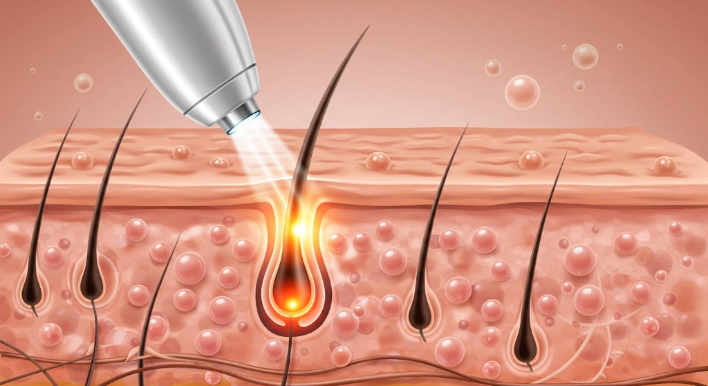 Qual tipo de Laser escolher para depilação definitiva em Uberlândia