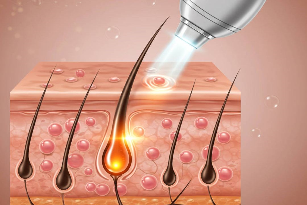 Melhor tecnologia de Laser de Diodo em Uberlândia na Clínica NeoSkin para remoção de pelos